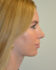 Rhinoplasty After Patient Thumbnail 1
