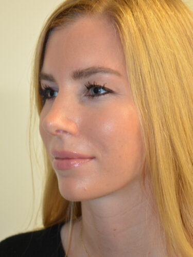 Rhinoplasty After Patient 4