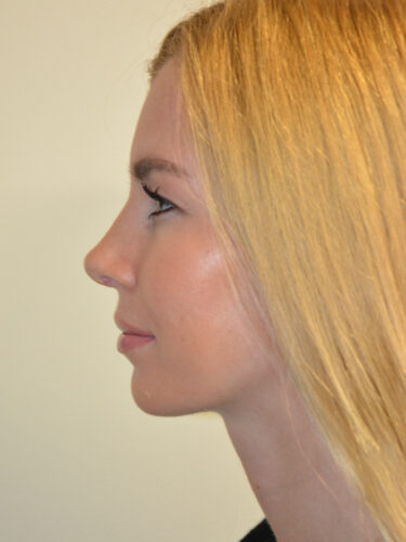 Rhinoplasty After Patient 3