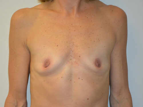 Breast Augmentation Before Patient 1