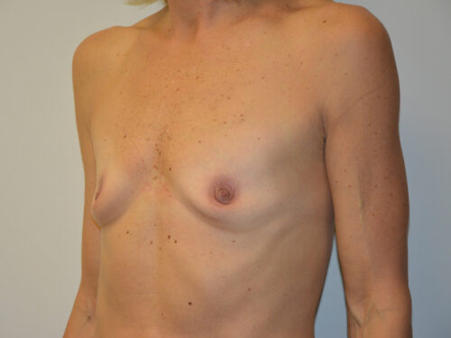 Breast Augmentation Before Patient 2