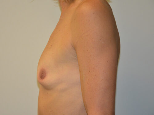 Breast Augmentation Before Patient 3