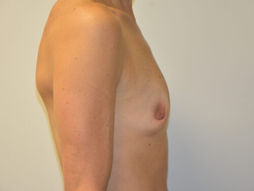 Breast Augmentation Before Patient 5