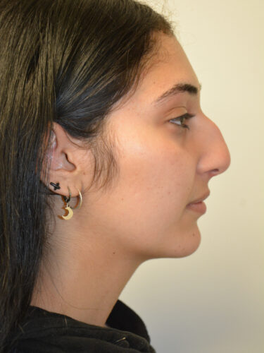 Rhinoplasty Before Patient 1