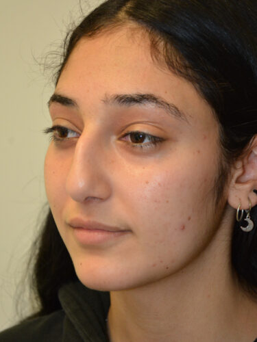 Rhinoplasty Before Patient 4