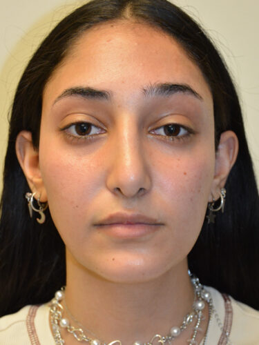 Rhinoplasty After Patient 5