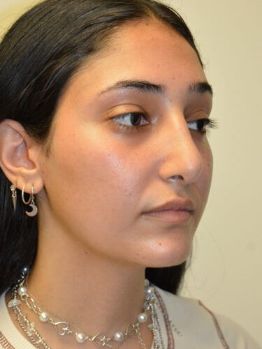 Rhinoplasty After Patient 2