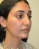 Rhinoplasty After Patient Thumbnail 2