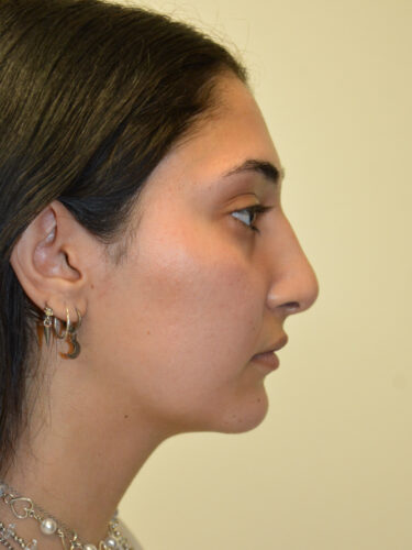 Rhinoplasty After Patient 1