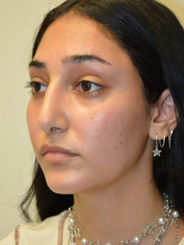 Rhinoplasty After Patient 4