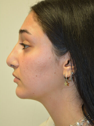 Rhinoplasty After Patient 3