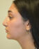 Rhinoplasty After Patient Thumbnail 3