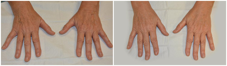 hand-rejuvenation-