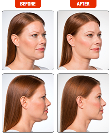 kybella