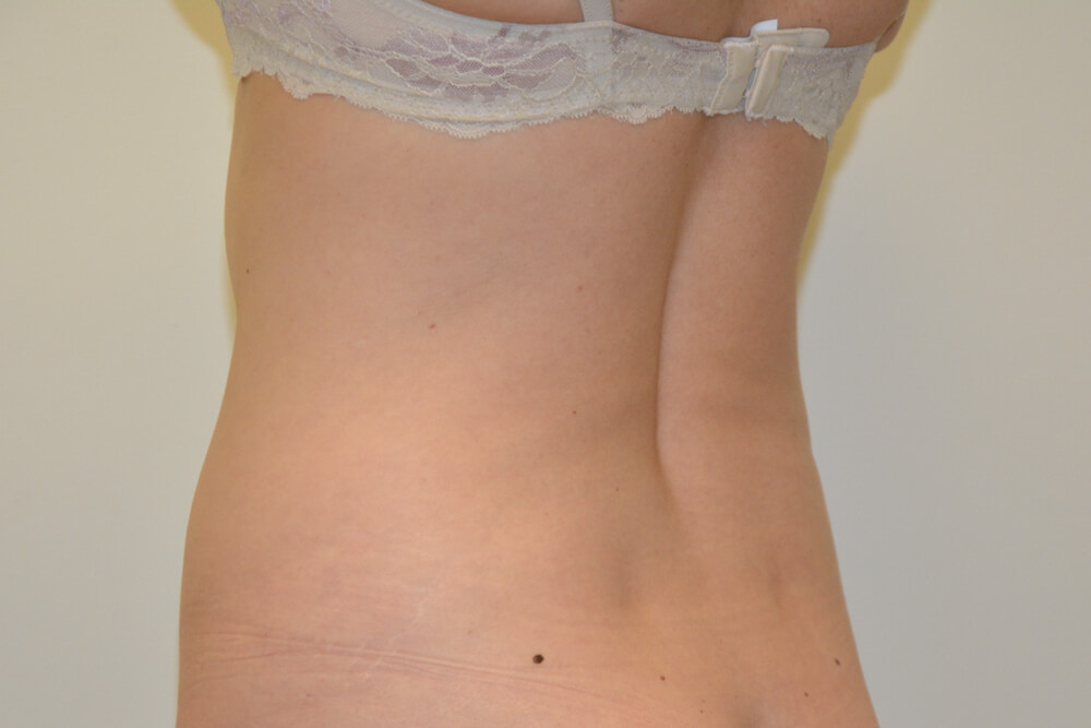 Liposuction-09 | Before Liposuction