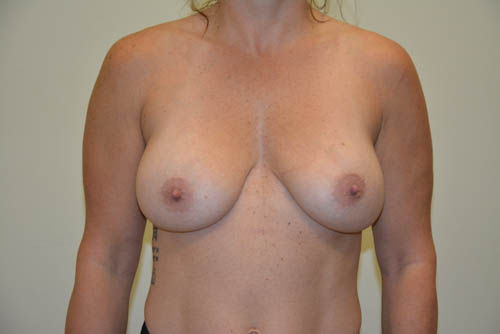 Implant-Removal-09 | Before Implant Removal