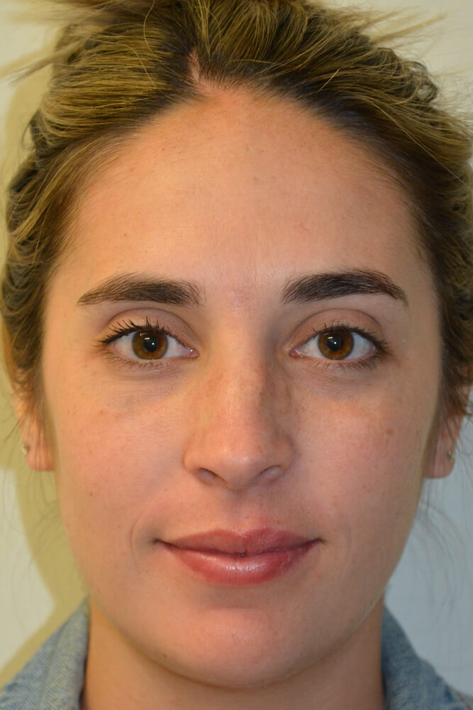 Rhinoplasty-10 | Before Rhinoplasty