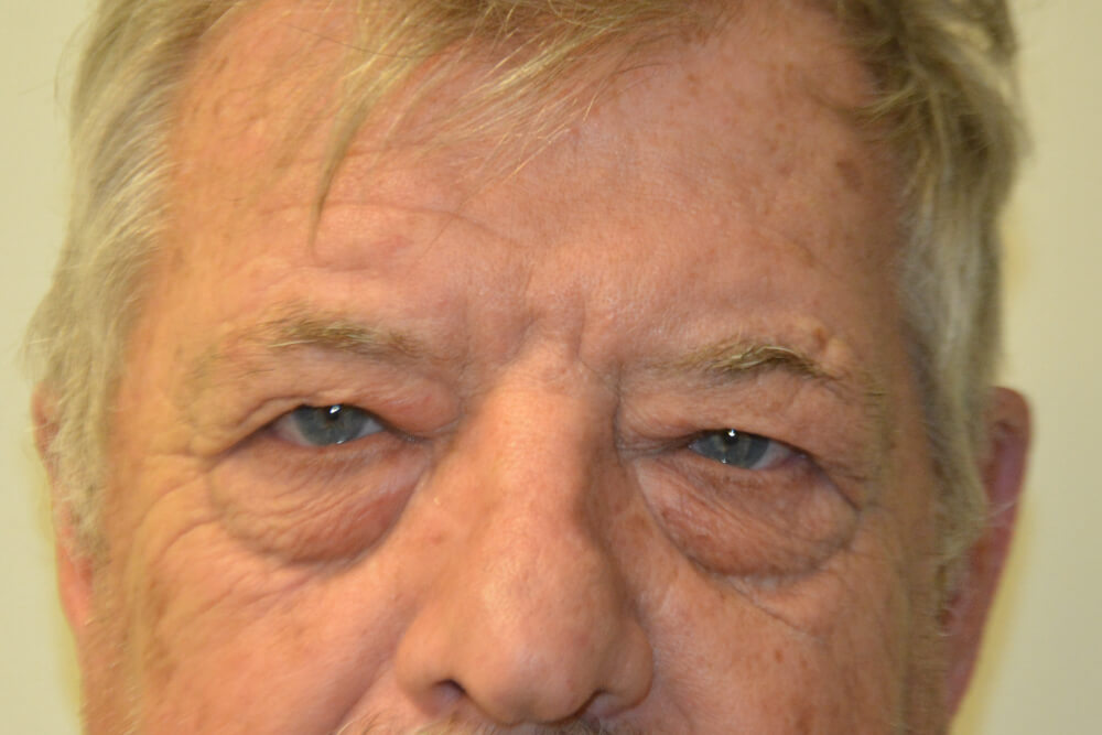 Eyelid-Surgery-01 | Before Eyelid Surgery 1