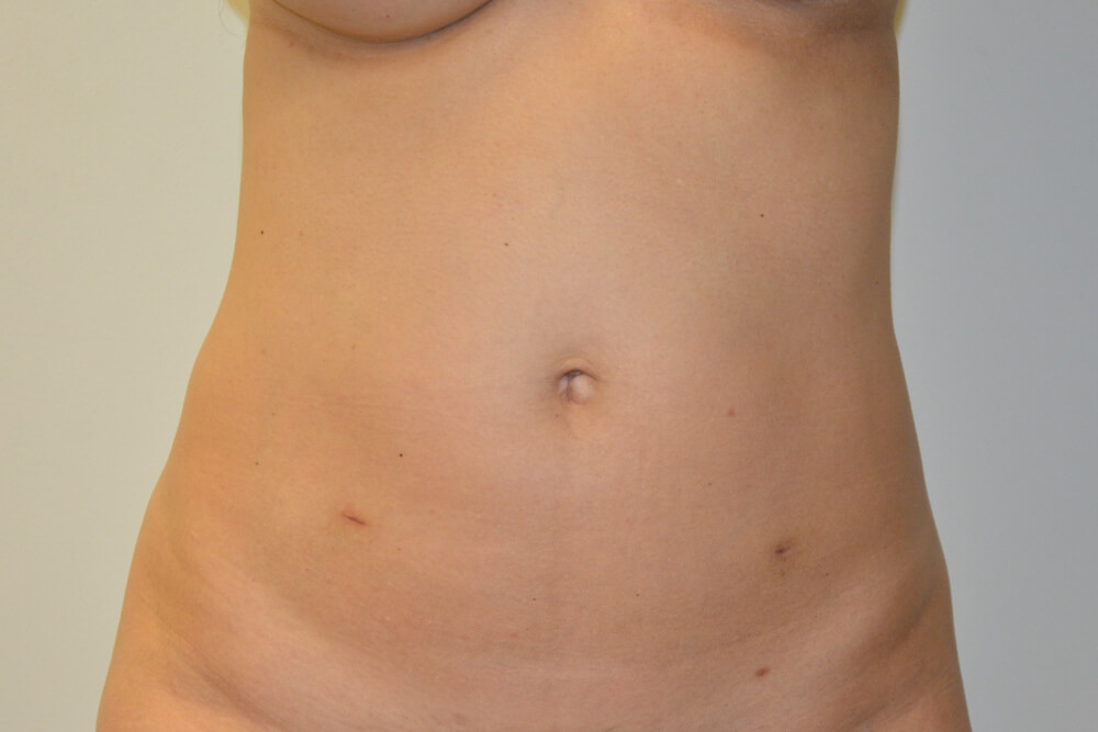 Mini-Tummy-Tuck-10 | Before Mini Tummy Tuck 1