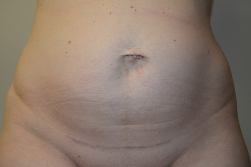 Tummy-Tuck-12 | Before Tummy Tuck