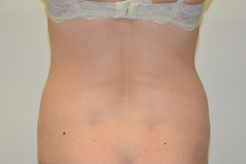 Liposuction-09 | Before Liposuction 2