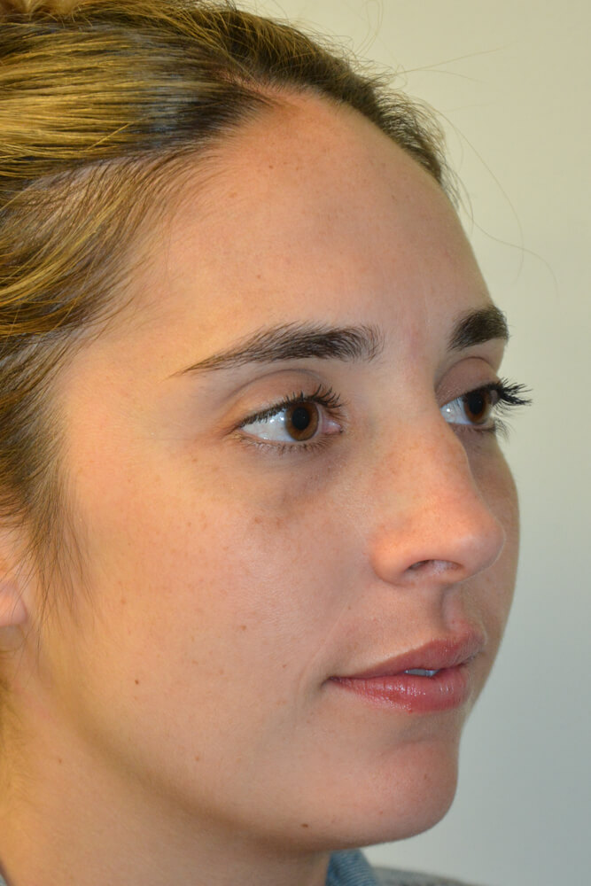 Rhinoplasty-10 | Before Rhinoplasty 2