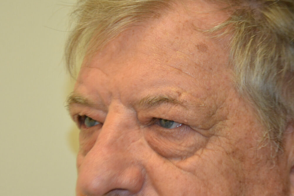 Eyelid-Surgery-01 | Before Eyelid Surgery 2