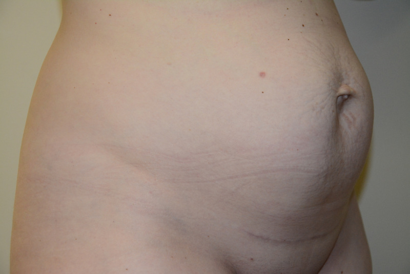 Tummy-Tuck-12 | Before Tummy Tuck 2