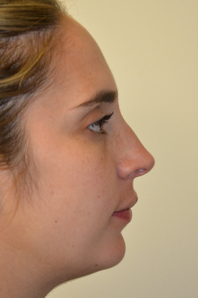 Rhinoplasty-10 | Before Rhinoplasty 3
