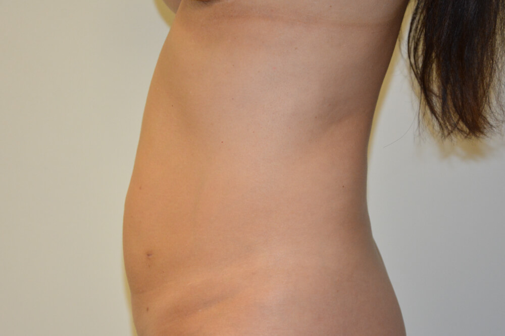Mini-Tummy-Tuck-10 | Before Mini Tummy Tuck 3