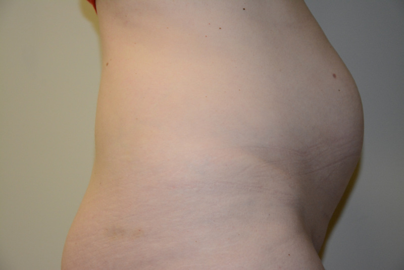 Tummy-Tuck-12 | Before Tummy Tuck 3