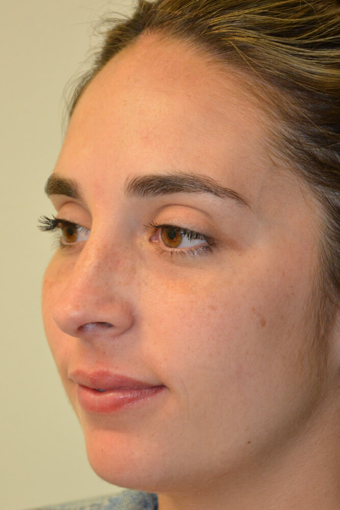 Rhinoplasty-10 | Before Rhinoplasty 4