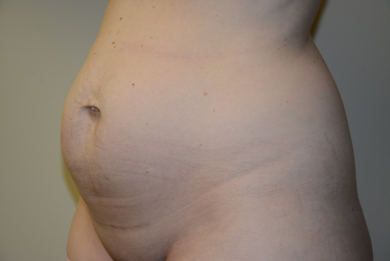 Tummy-Tuck-12 | Before Tummy Tuck 4