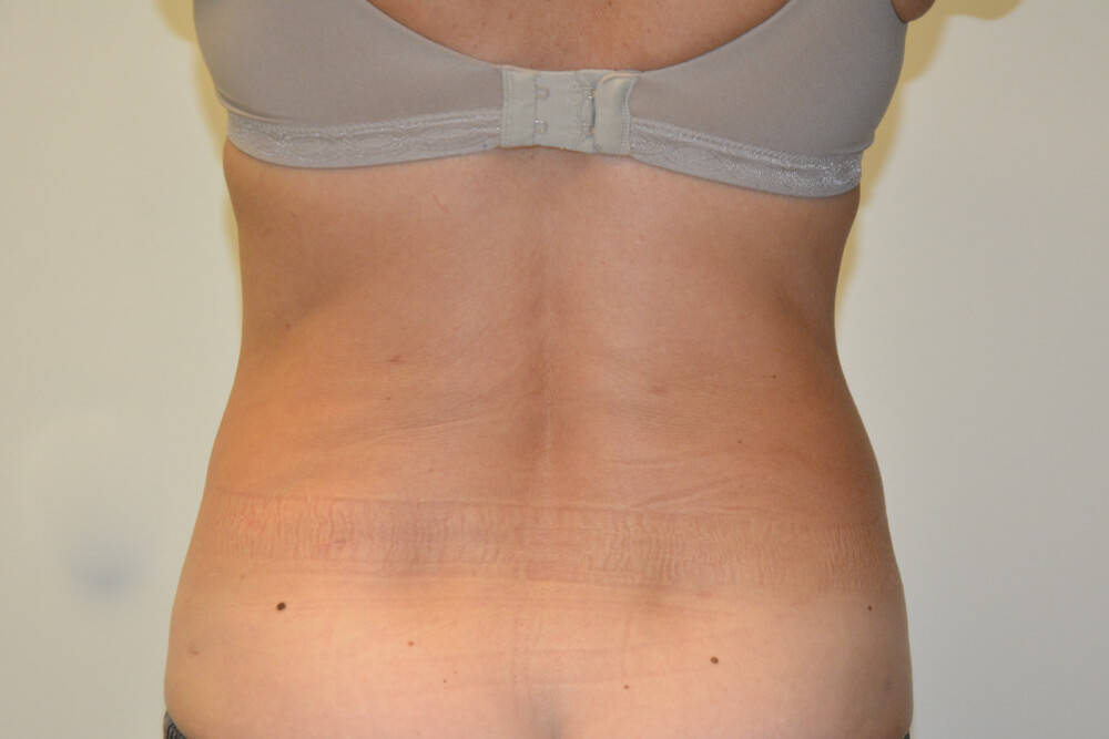 Liposuction-09 | After Liposuction 2