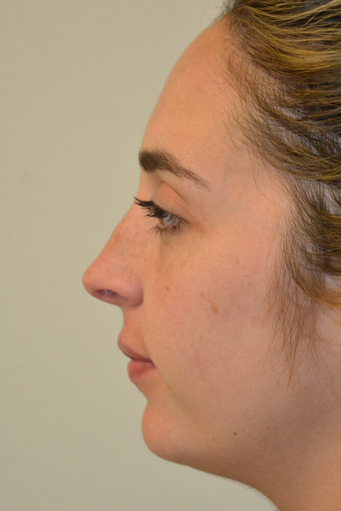 Rhinoplasty-10 | Before Rhinoplasty 5