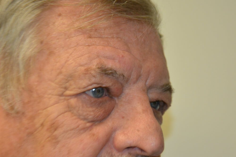 Eyelid-Surgery-01 | Before Eyelid Surgery 4