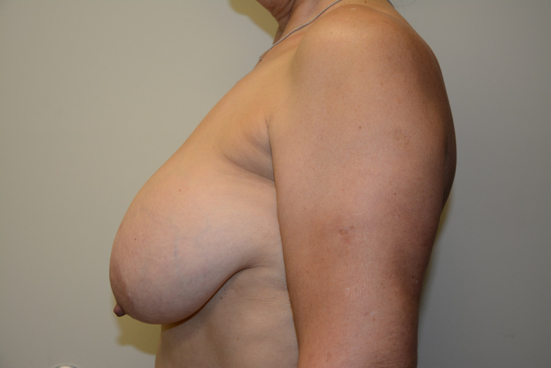 Breast-Reduction-10 | Before Breast Reduction 5