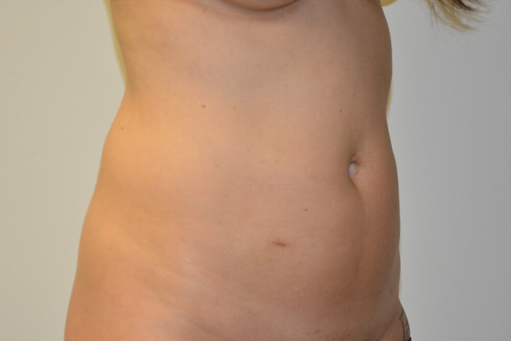 Mini-Tummy-Tuck-10 | Before Mini Tummy Tuck 5