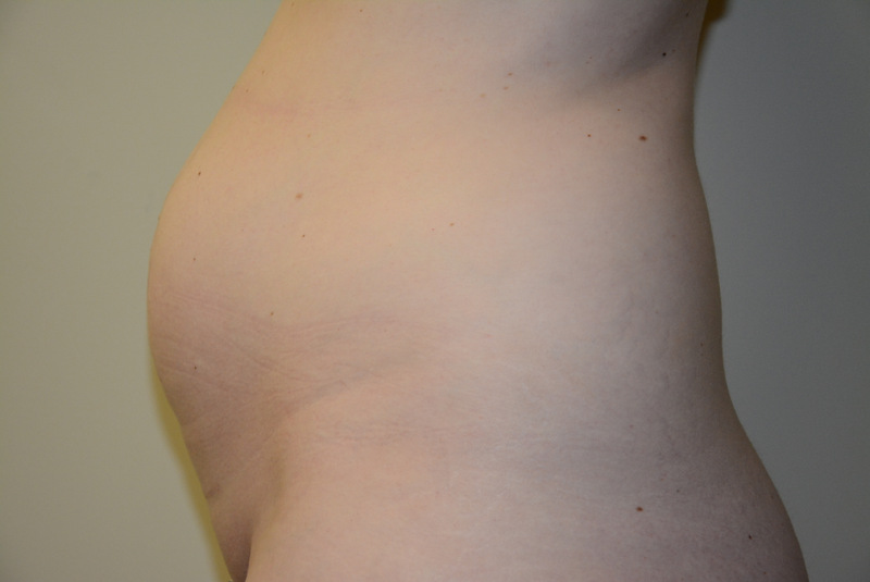 Tummy-Tuck-12 | Before Tummy Tuck 5