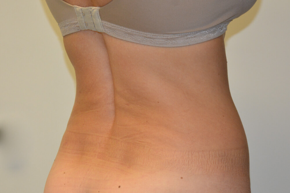 Liposuction-09 | After Liposuction 3