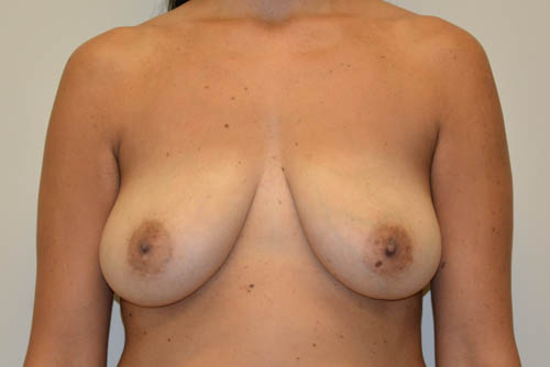 Breast-Lift-and-Augmentation-09 | Before Breast Lift and Augmentation