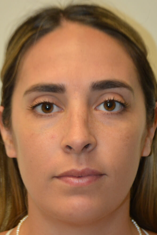 Rhinoplasty-10 | After Rhinoplasty