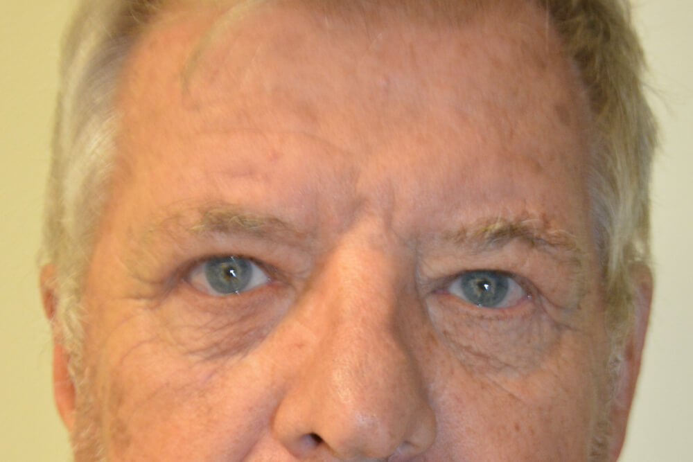 Eyelid-Surgery-01 | After Eyelid Surgery 1