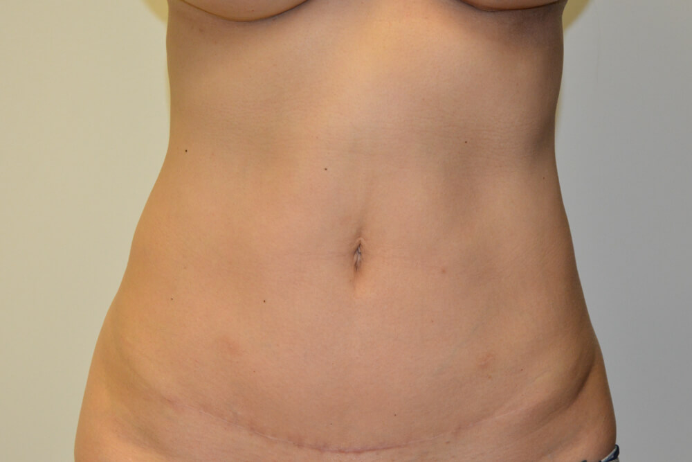 Mini-Tummy-Tuck-10 | After Mini Tummy Tuck 1