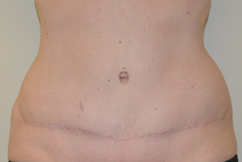 Tummy-Tuck-12 | After Tummy Tuck