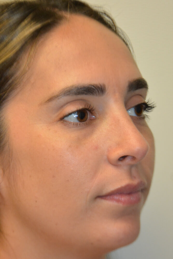 Rhinoplasty-10 | After Rhinoplasty 2