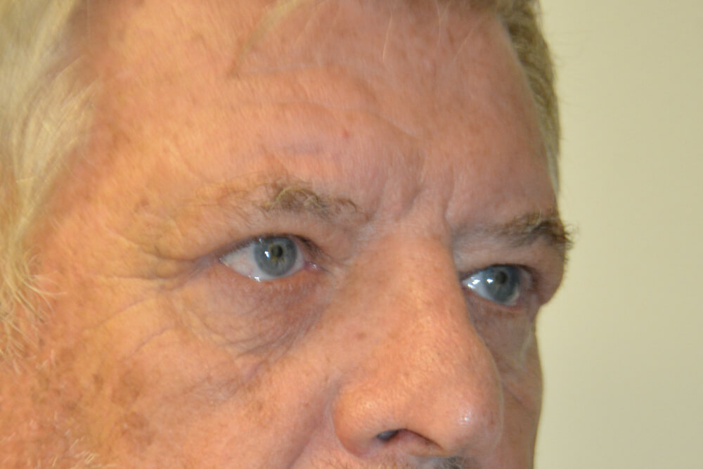Eyelid-Surgery-01 | After Eyelid Surgery 4