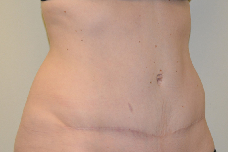 Tummy-Tuck-12 | After Tummy Tuck 2
