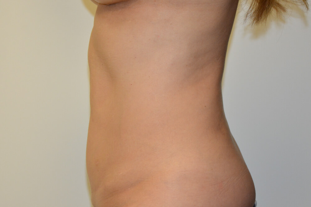 Mini-Tummy-Tuck-10 | After Mini Tummy Tuck 3