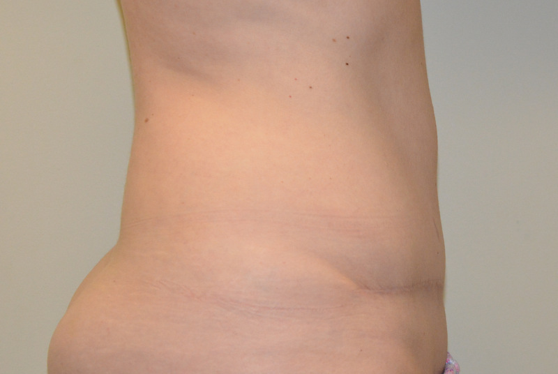 Tummy-Tuck-12 | After Tummy Tuck 3